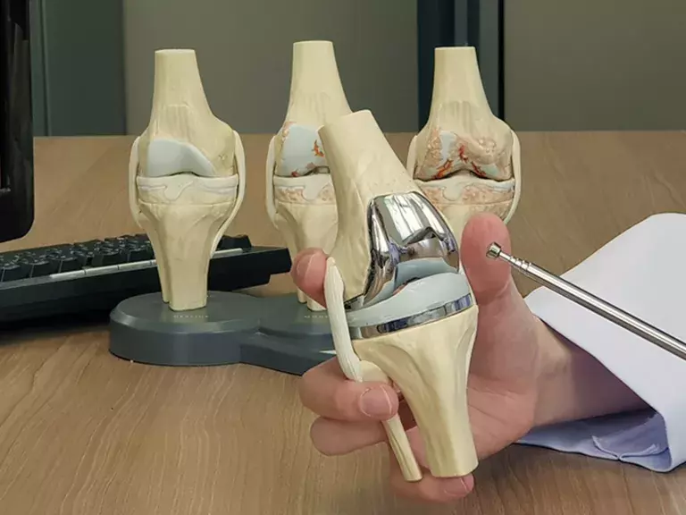 Teaser image of model of a knee replacement